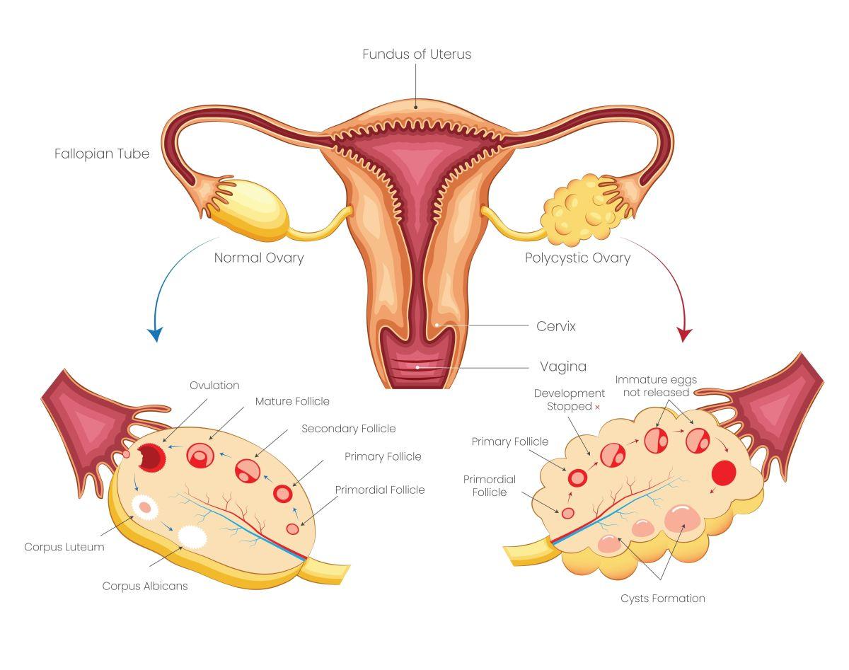 De la dereglări menstruale la infertilitate: adevărul despre sindromul ovarelor polichistice