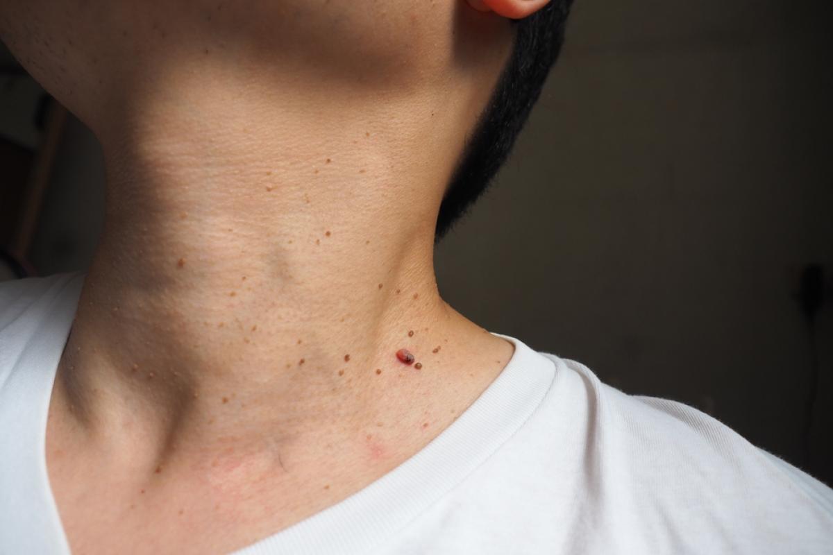 Tot ce trebuie să știi despre papiloame – când sunt periculoase și cum se tratează