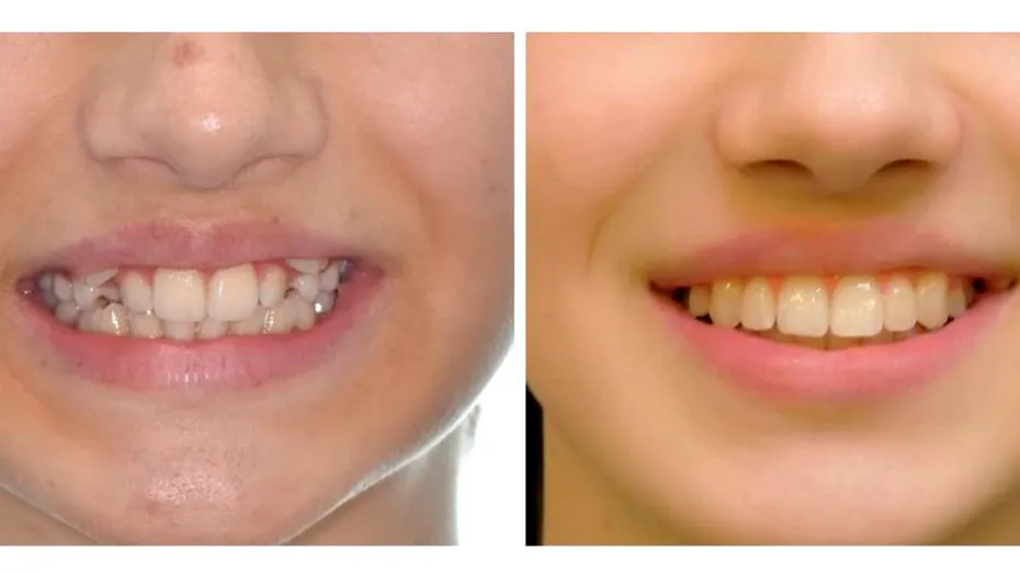 Caninii ectopici: ce sunt, cum îi recunoști și ce opțiuni de tratament există