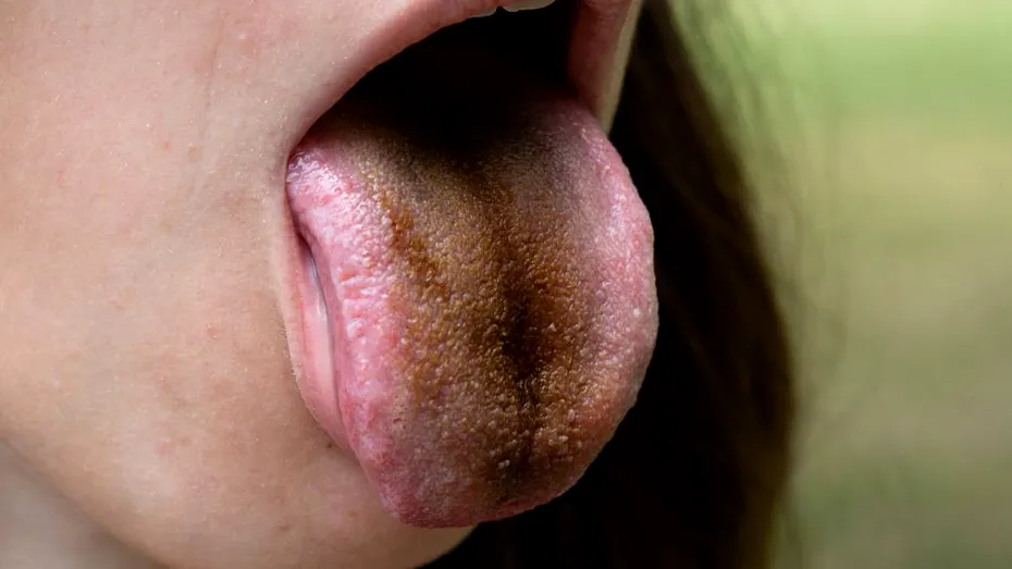 Ce înseamnă limba neagră-păroasă şi ce factori o pot declanşa