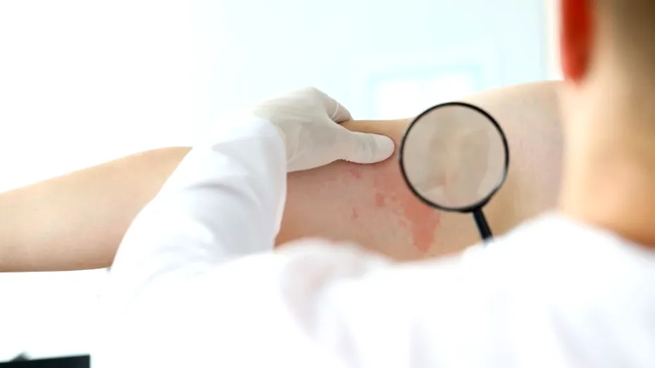 Lepra reapare în România după mai bine de 40 de ani: ce simptome are boala și cum se tratează