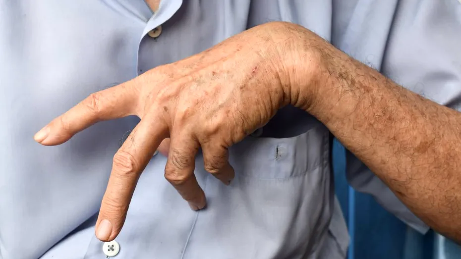 Complicația care poate apărea după un AVC și îți blochează mișcările. Ce este spasticitatea și de ce trebuie depistată rapid