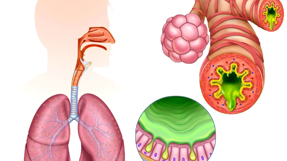 Inflamația cronică, „dușmanul invizibil” al sănătății: ce este și cum ne afectează