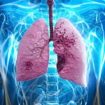 Mituri despre cancerul pulmonar: ce este adevărat și ce trebuie să știi de fapt